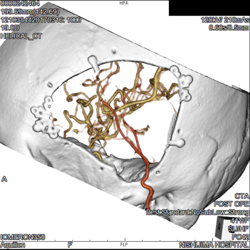 頭部血管3DCTA画像