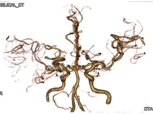 頭部血管3DCTA画像